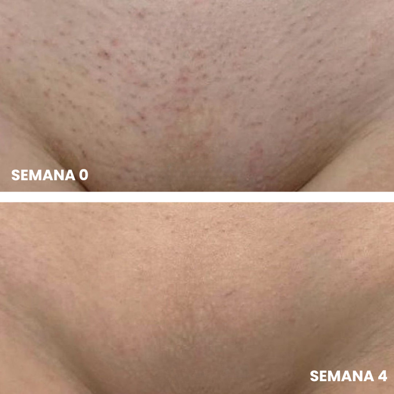 Belkare™ Aceite de Cyperus Rotundus