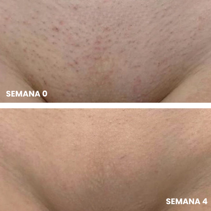 Belkare™ Aceite de Cyperus Rotundus